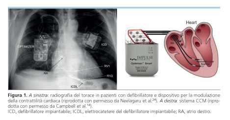 modello cardiaco del solco coronarico